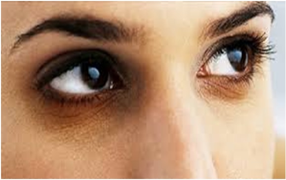 Dark Circles around eyes and simple remedies