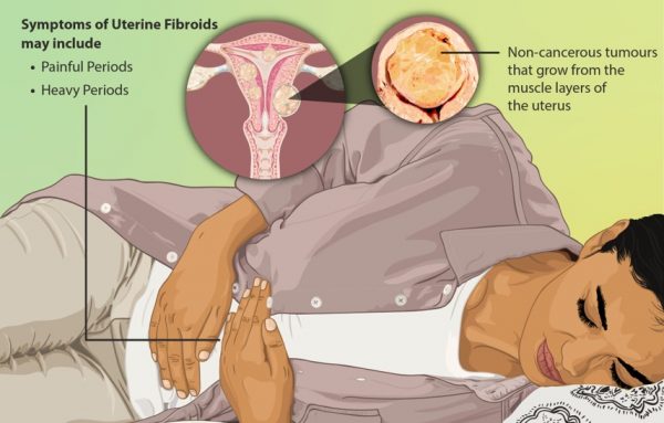 Uterine Fibroid Pain Relief