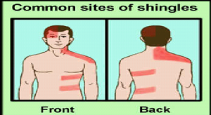 WHAT DO YOU KNOW ABOUT SHINGLES?