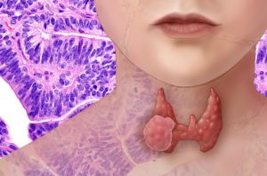 JANUARY IS THYROID AWARENESS MONTH