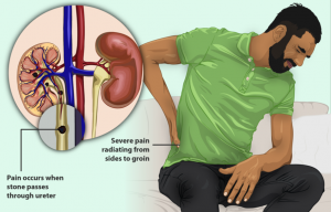 Kidney Stones