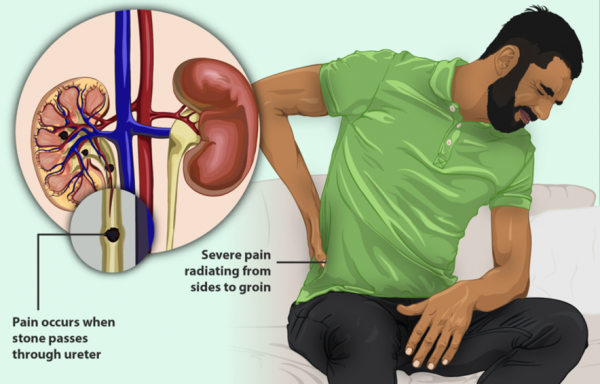 Kidney Stones
