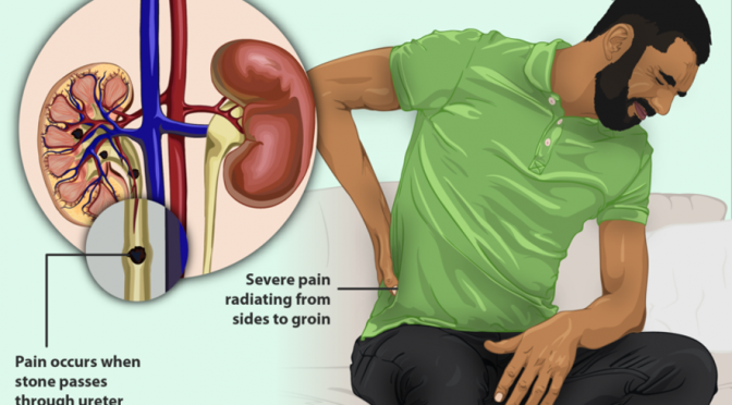Kidney Stones