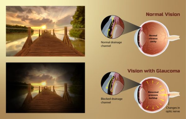 Glaucoma - Silent Thief of Sight