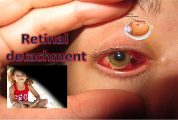 Retinal Detachment