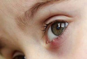 Stye - Eyelid Cyst