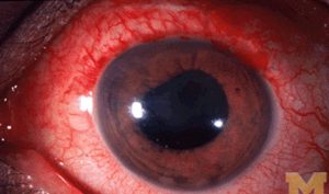 Uveitis
