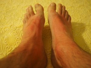 Skin Care Tips For Diabetic Patients
