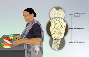 Avoid Bone Sucking Food and Get Proper Nutrition