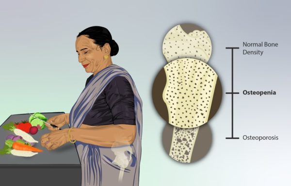 Avoid Bone Sucking Food and Get Proper Nutrition