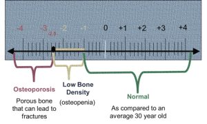 Bone Density Test