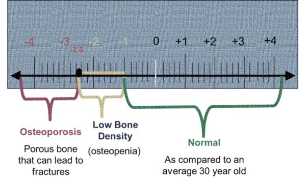 Bone Density Test
