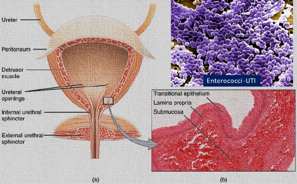 Common causes and remedies for Urinary Tract Infection