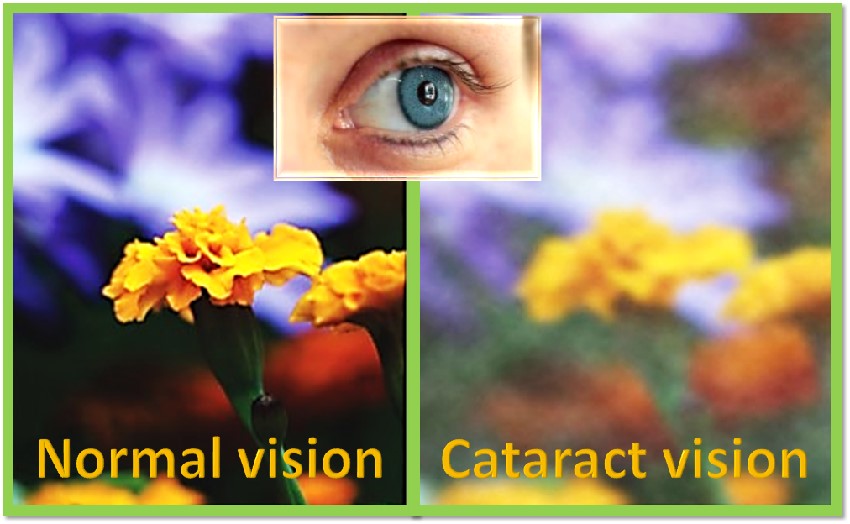 Cataract Vision