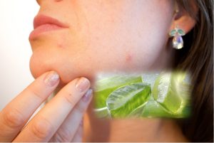 Aloe Vera Gel For Pimple, Black Pigmentation