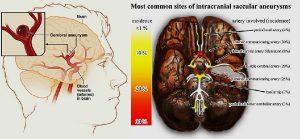Brain aneurysm