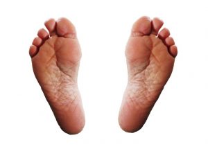 Cracked heels – what is the solution?