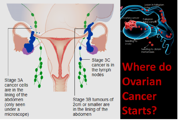 Ovarian cancer originates from Fallopian tubes!