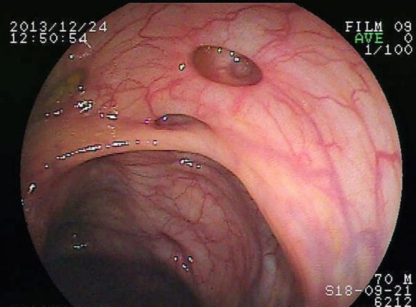 Inflammatory bowel disease