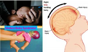 Shaken baby syndrome