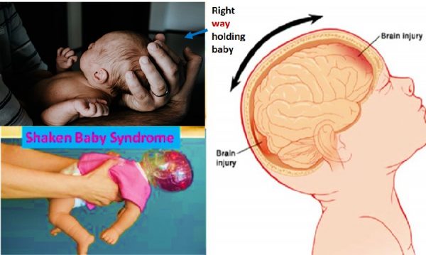 Shaken baby syndrome