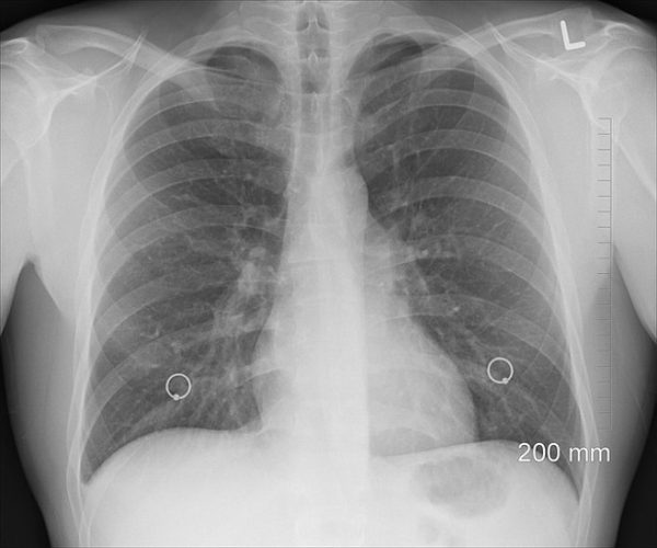 Mesothelioma