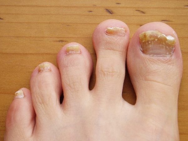 Toenail infection