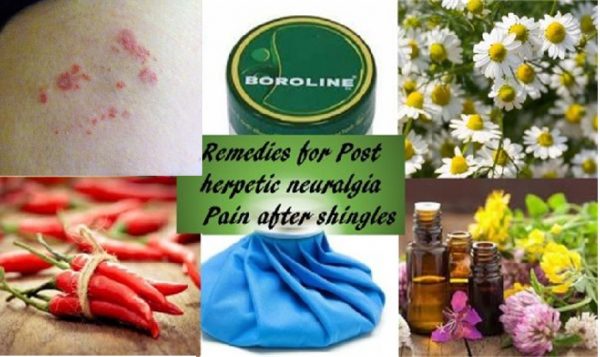 Remedies for shingles