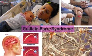 Guillain Barre Syndrome