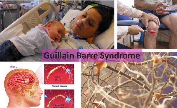 Guillain Barre Syndrome