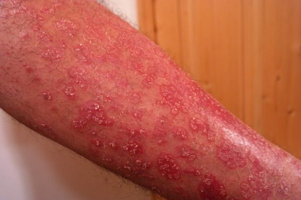 Food choice for psoriasis