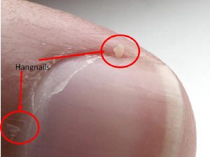 Hangnails home remedies
