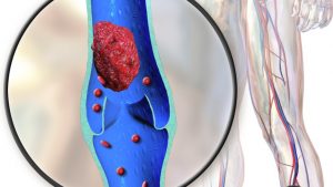 Deep Vein Thrombosis
