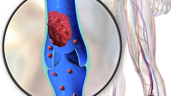 Deep Vein Thrombosis