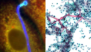 What are the types of mucormycosis infections?