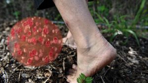 Melioidosis infection in USA