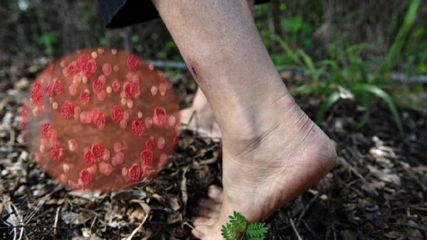 Melioidosis infection in USA