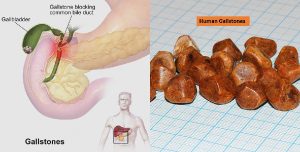 Gallstone prevention tips
