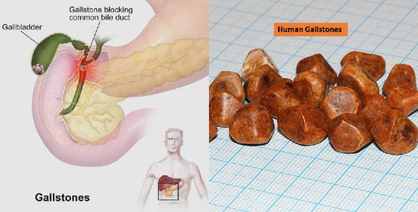 Gallstone prevention tips