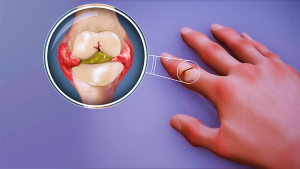 How To Manage Autoimmune Joint Inflammation RA -Rheumatoid Arthritis