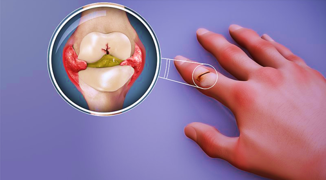 How To Manage Autoimmune Joint Inflammation RA -Rheumatoid Arthritis