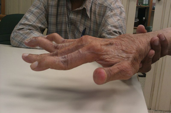 What Happens In Rheumatoid Arthritis?