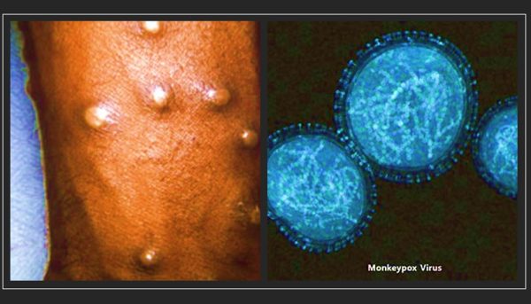 Monkeypox symptoms