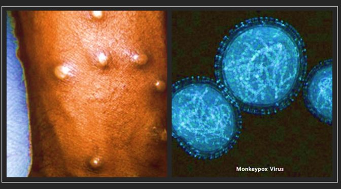 Monkeypox symptoms