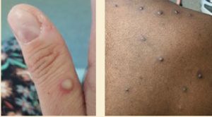 Monkey pox rashes