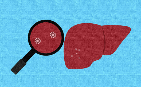 Hepatitis Infection of Liver