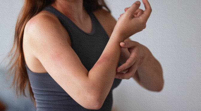 Herpes Shingles