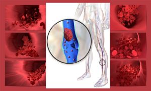 Blood clot prevention