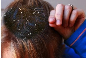 Dandruff home remedies