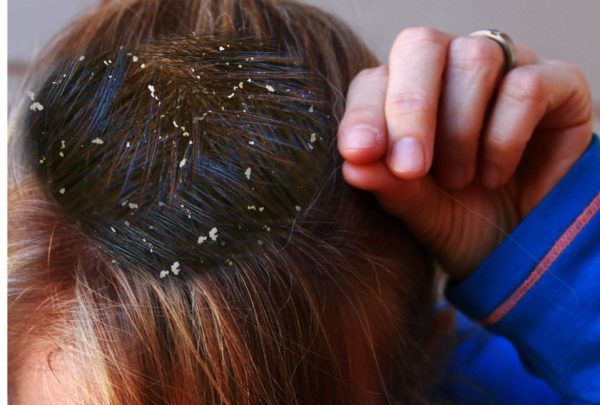 Dandruff home remedies